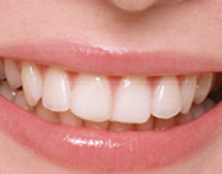 訪問歯科　徳島市　歯の訪問治療