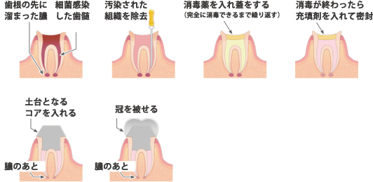 歯根の治療 徳島　ていねいな歯科治療