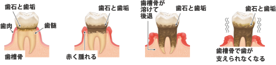 SEIDA式歯ぐきマッサージ